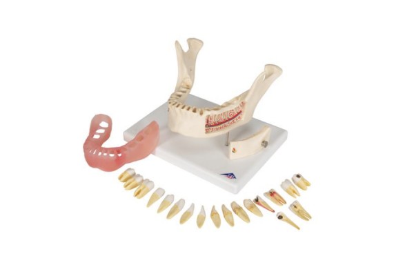 model choroby zębów, powiększony 2 razy, 21 części - 1000016 [d26] 3b scientific modele anatomiczne 2